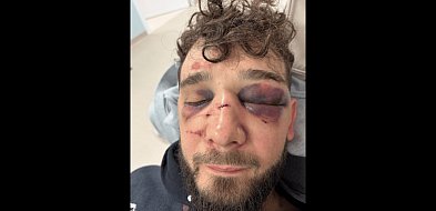Zobaczcie co zrobiliście! BRUTALNE POBICIE po święcie miasta. 6 na 1