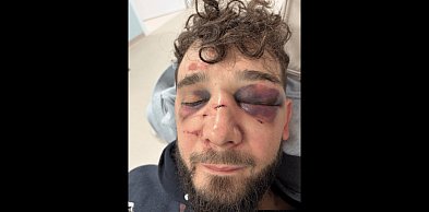 Zobaczcie co zrobiliście! BRUTALNE POBICIE po święcie miasta. 6 na 1